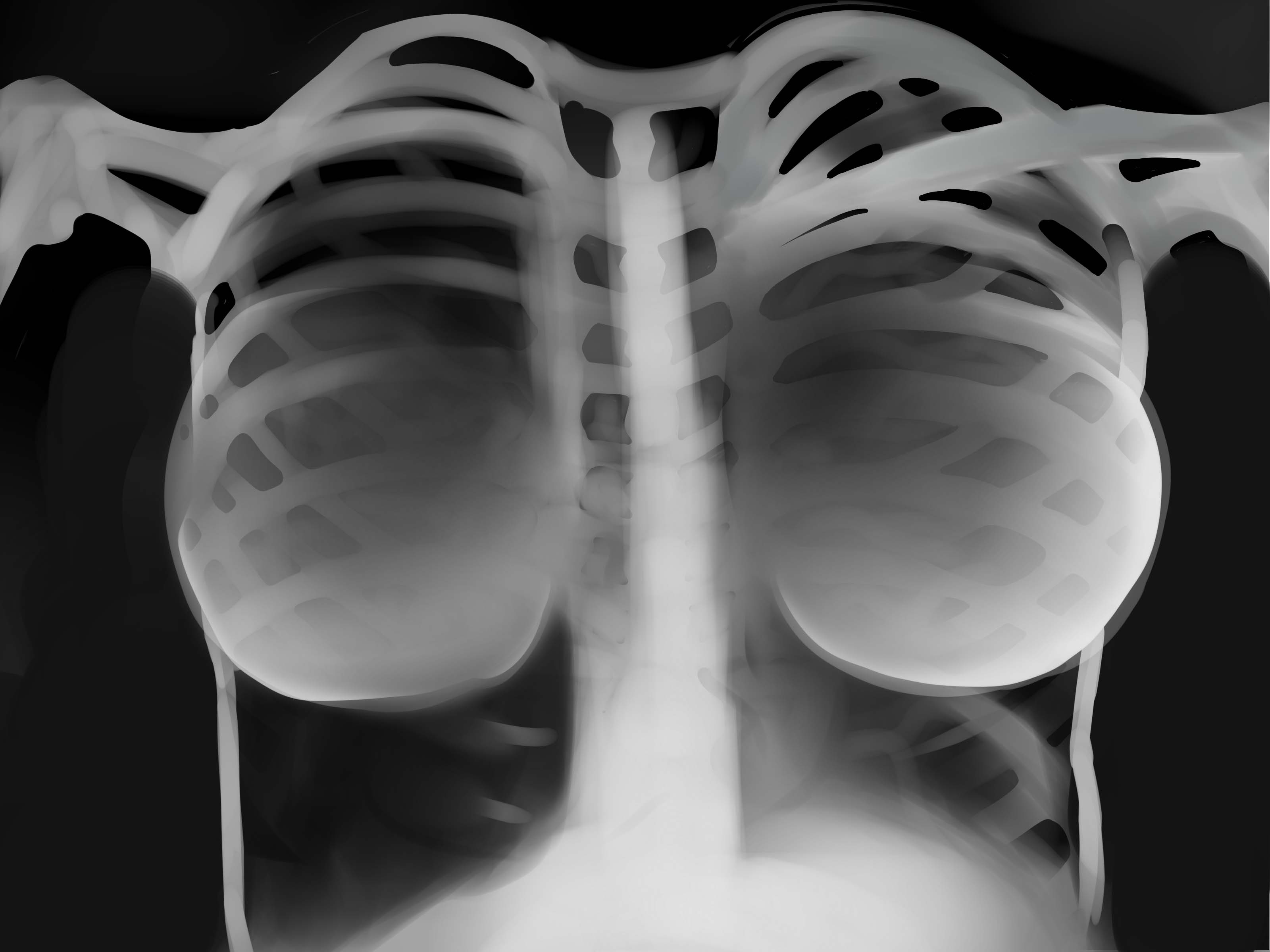 Видно ли на снимке. Рентгеновский снимок грудной клетки. Рентгенограмма груди. Импланты груди на рентгене.